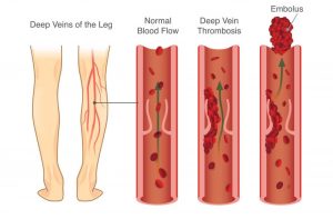Figure 1: DVT effect on leg of patient